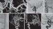 Y Stent-Assisted Coiling Technique for Bifurcation Aneurysms Using Double Neuroform® Stent: a Large Restrospective Series.