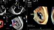 A true bicuspid tricuspid valve: 3D imaging to better understanding the forgotten valve.