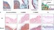 Targeting tumour surface collage with hydrogel probe: a new strategy to enhance intraoperative imaging sensitivity and stability of bladder cancer.