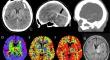 Endovascular treatment of deep sinus vein thrombosis 72 h after initial cardioembolic stroke