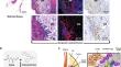 Sustained delivery of celecoxib from nanoparticles embedded in hydrogel injected into the biopsy cavity to prevent biopsy-induced breast cancer metastasis.