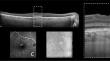 The "triple-layer sign": an optical coherence tomography signature for the detection of non-exudative macular neovascularization.