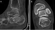 Is the occurrence of extra-articular calcaneal fractures of the joint depression type related to osteoporosis and aging?