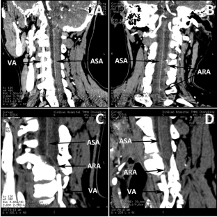 Occlusion of vertebral artery and anterior spinal artery in cervical facet dislocation: a prospective study using computed tomography angiography.