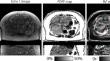 Free-breathing MRI techniques for fat and R<sub>2</sub>* quantification in the liver.