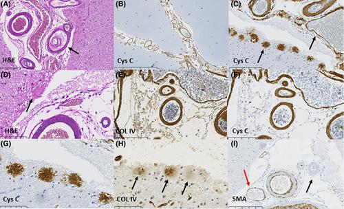 The historical background of hereditary cystatin C amyloid angiopathy: Genealogical, pathological, and clinical manifestations.