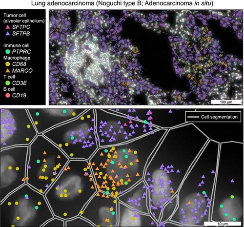 Spatial omics technologies for understanding molecular status associated with cancer progression