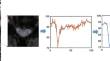 Pre-operative spinal cord perfusion quantified by DSC MRI as a predictor of post-operative prognosis in patients with cervical spondylotic myelopathy.