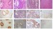 Expression of miR-34a, RASSF1A and E-cadherin in relation to PRB in endometrioid carcinoma and its precursor.