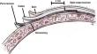 Cranial stair-step incision for minimizing postoperative complications in neuro-oncologic surgery: A propensity score-matched analysis.