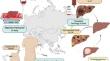 Trends of liver transplantation in Asia.