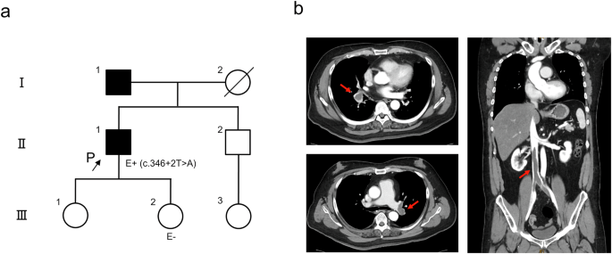 Investigation of a novel PROS1 splicing variant in a patient with protein S deficiency.