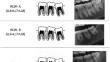 Root canal widths of mandibular molars in predicting the legal age threshold 18 years in a sample of juveniles and sub-adults of south-indian origin: an orthopantomographic study.