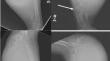 Hemophilic pseudotumor in the bilateral forearms: a unique case report.