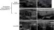 Risk stratification for central lymph node metastasis in mono-focal papillary thyroid carcinoma patients with encapsulated tumor as confirmed by preoperative ultrasound: a multi-center analysis.