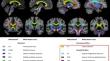 Functional and structural brain connectivity in disorders of consciousness.