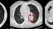 Improving lung nodule segmentation in thoracic CT scans through the ensemble of 3D U-Net models.