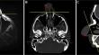 Squamous cell carcinoma of the nasal vestibule: a diagnostic and therapeutic challenge.