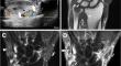 Extrapulmonary hyalinizing granuloma: a rare case with intra-articular and tenosynovial involvement.