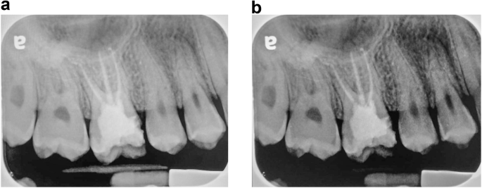 Endodontic radiography - what’s displaying the radiograph? The yield of commercial computer screens vs. DICOM calibrated medical screens in endodontic radiography