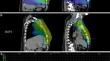 Proton therapy reduces the effective dose to immune cells in breast cancer patients.