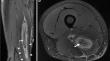 Degloving intramuscular injuries of the semimembranosus and adductor longus muscles in adolescent soccer players.