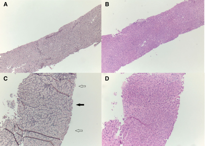 Rapid Development of Post-Liver Transplantation Nodular Regenerative Hyperplasia and Portal Hypertension After Perfusion Pump Use: A Case Series.