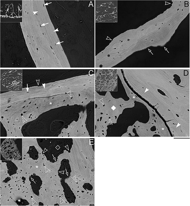 Sclerotic prostate cancer bone metastasis: woven bone lesions with a twist.