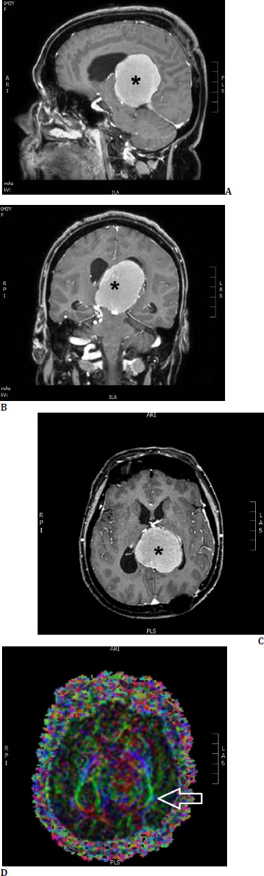 Protecting vision with intraoperative visual evoked potentials and tractography in transcortical brain tumor surgery.