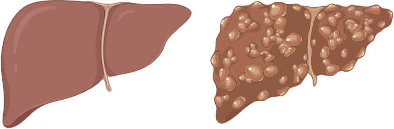 Development of a flexible liver phantom for hepatocellular carcinoma treatment planning: a useful tool for training & education.