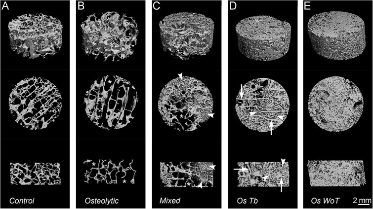 Sclerotic prostate cancer bone metastasis: woven bone lesions with a twist.