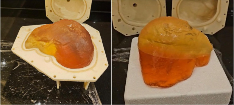 Development of a flexible liver phantom for hepatocellular carcinoma treatment planning: a useful tool for training & education.