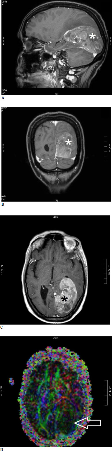Protecting vision with intraoperative visual evoked potentials and tractography in transcortical brain tumor surgery.