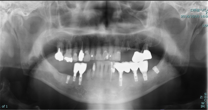 Long-term follow-up of a patient with Parkinson's disease under nursing care after replacement of fixed implant-supported prostheses with an implant overdenture: a case report.