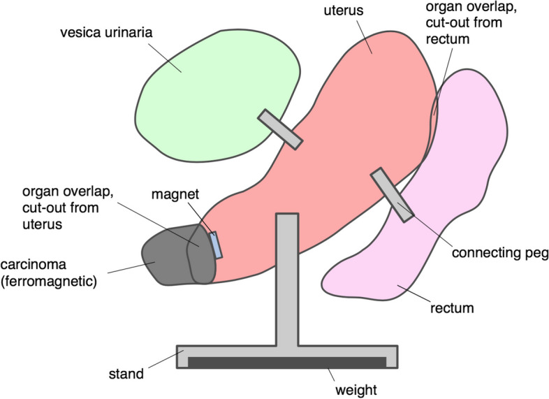 Evaluating the value of individualized 3D printed models for examination, diagnosis and treatment planning of cervical cancer.