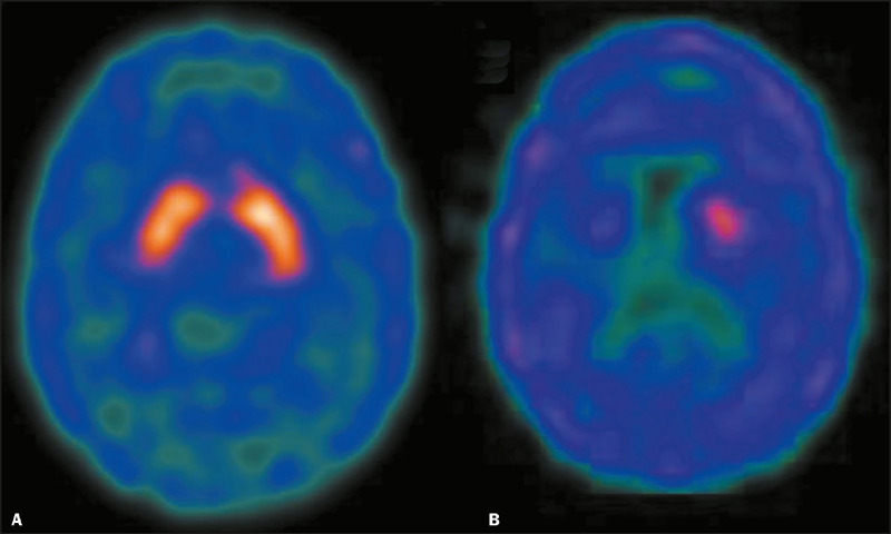 Parkinson's disease and levodopa-induced dyskinesias: a quantitative analysis through <sup>99m</sup>Tc-TRODAT-1 SPECT imaging of the brain.