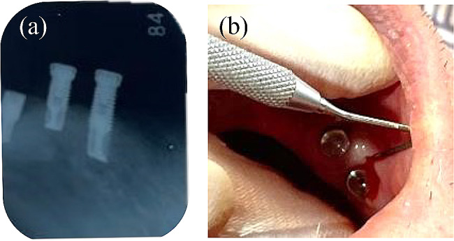 Long-term follow-up of a patient with Parkinson's disease under nursing care after replacement of fixed implant-supported prostheses with an implant overdenture: a case report.