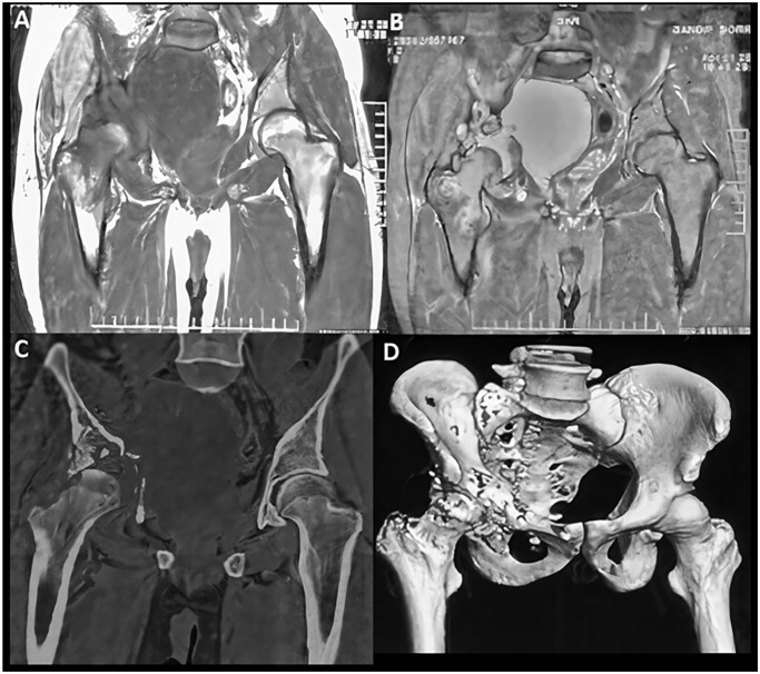 A Diagnostic Perplexity in Primary Pelvic Hydatid Disease, Mimicking Tumor and Tuberculosis: A Case Report.