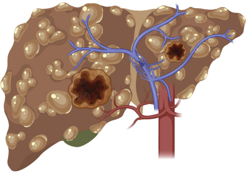 Development of a flexible liver phantom for hepatocellular carcinoma treatment planning: a useful tool for training & education.