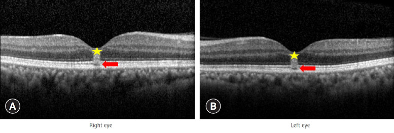 Solar retinopathy related to antidepressant use in a patient with major depressive disorder: a case report.