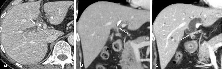 Preoperative CT and MRI assessment of the longitudinal tumor extent of extrahepatic bile duct cancer after biliary drainage