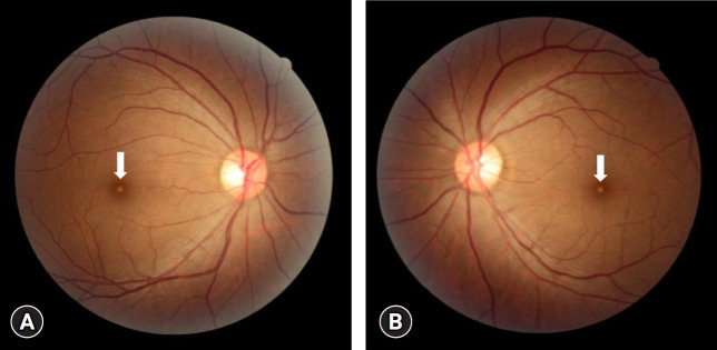 Solar retinopathy related to antidepressant use in a patient with major depressive disorder: a case report.