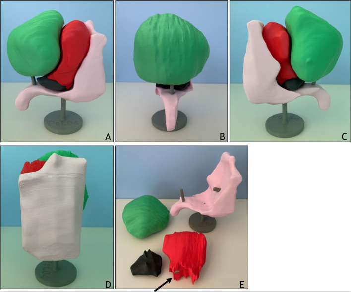 Evaluating the value of individualized 3D printed models for examination, diagnosis and treatment planning of cervical cancer.