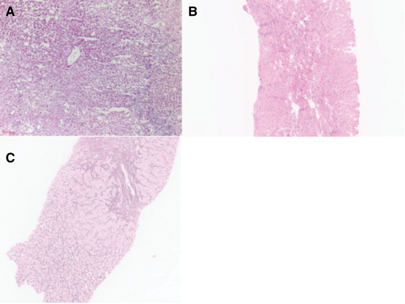 Rapid Development of Post-Liver Transplantation Nodular Regenerative Hyperplasia and Portal Hypertension After Perfusion Pump Use: A Case Series.