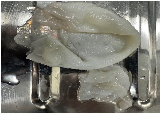 A Diagnostic Perplexity in Primary Pelvic Hydatid Disease, Mimicking Tumor and Tuberculosis: A Case Report.