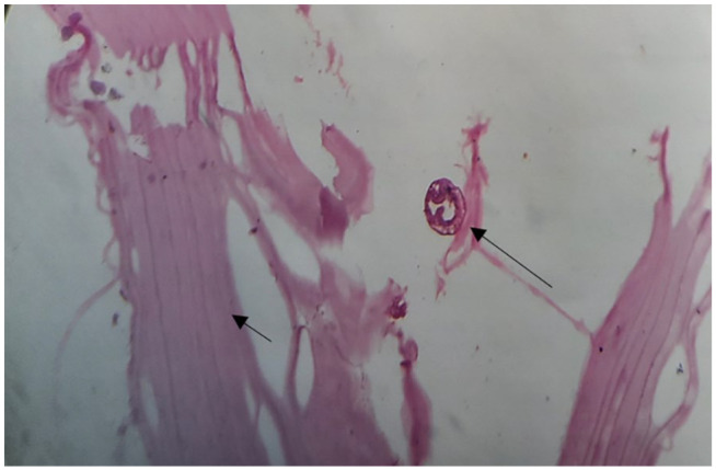 A Diagnostic Perplexity in Primary Pelvic Hydatid Disease, Mimicking Tumor and Tuberculosis: A Case Report.