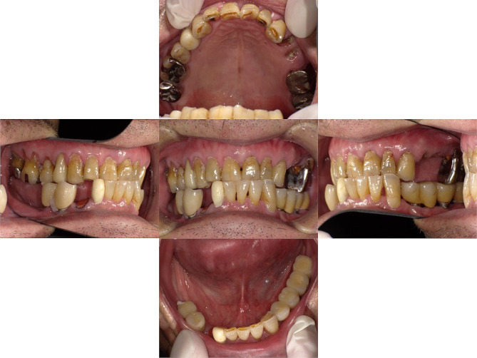 Long-term follow-up of a patient with Parkinson's disease under nursing care after replacement of fixed implant-supported prostheses with an implant overdenture: a case report.