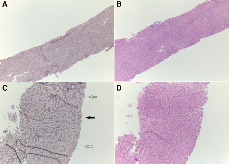 Rapid Development of Post-Liver Transplantation Nodular Regenerative Hyperplasia and Portal Hypertension After Perfusion Pump Use: A Case Series.
