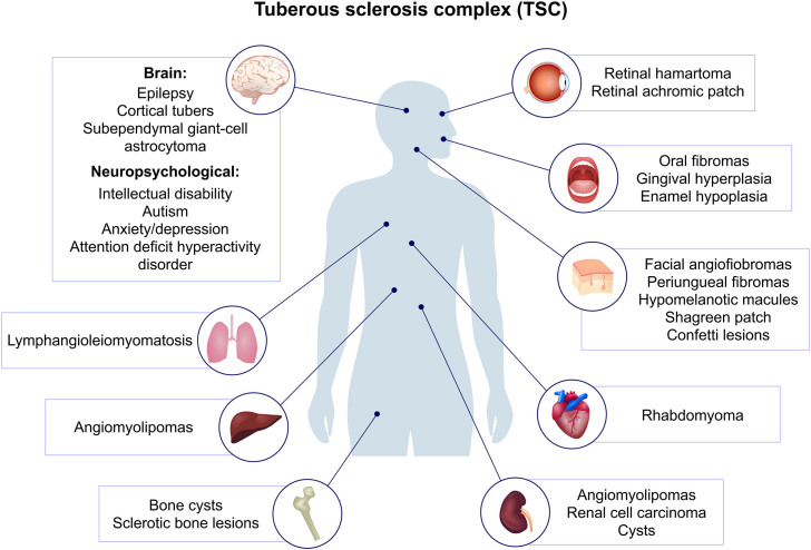 Tuberous Sclerosis Complex and the kidneys: what nephrologists need to know.