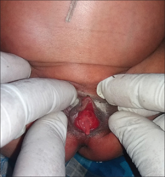Female Anorectal Malformation with Genitourinary Prolapse: A Rare Association.